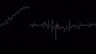 EMG myopathic vastus lateralis [upl. by Wernda]