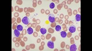 Pathology  dr Nafea  Acute lymphoblastic leukemia ALL أورام [upl. by Lynad353]