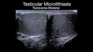 Testicular Microlithiasis [upl. by Nosidam705]