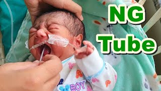 Nasogastric NG Tube Insertion in NeonateNewborn  Orogastric OG TubeFeeding Tube  Paediatric [upl. by Jews679]