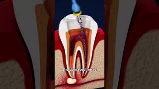 How to treat infected tooth Find out shorts [upl. by Neeham]