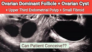 Ultrasound Dominant Follicle and Ovarian Cyst  Small Endometrial Polyp [upl. by Un233]