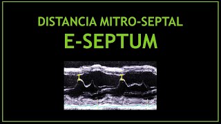 Midiendo la Distancia Mitro Septal Funcion sistolica  Ecocardiograma [upl. by Nylassej436]