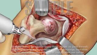 Total Hip Replacement Surgery Medical Animation [upl. by Enomar]