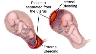 What is antepartum haemorrhage😷How to manage APHdrsaminakhurshidgynaecolog4661 [upl. by Yeaton740]