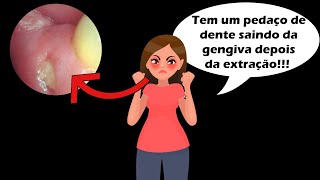 Pedaço de Dente Saindo da Gengiva Após Extração  Descubra o Que Fazer e Como Tratar o Problema [upl. by Nylarac945]