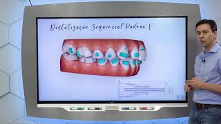 Aula 16  Protocolo de tratamento da Classe II com alinhadores [upl. by Rafter560]