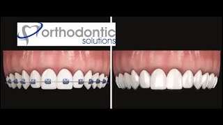 Clear Aligners vs Braces  ODS Aligners by Orthodontic Solutions [upl. by Kahcztiy434]