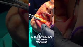 BUCCAL FAT REMOVALbuccalfatremovaldranirbanghoshaestheticsurgeryskintreatment [upl. by Gardas]