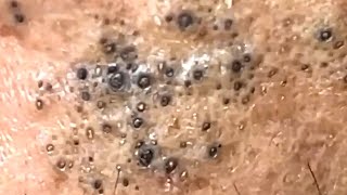 Blackheads Satisfying Removal 0003 [upl. by Tal993]