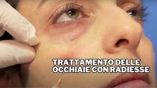 Trattamento delle Occhiaie con Radiesse Dr F Bernardini [upl. by Graniah149]