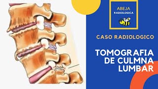 Tomografía de columna lumbar quotCaso radiológicoquot ESPONDILOLISTESIS [upl. by Alger]