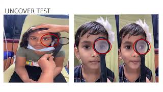 Strabismus by Dr Remya Edachery MVUPGO [upl. by Stan]