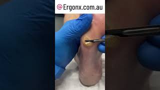 Slow motion corn and callus cutting from foot in podiatry clinic [upl. by Campy]