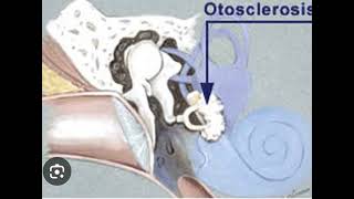 Otosclerosis [upl. by Oicatsana]