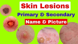 Type of skin lesions with name and picture  Primary and secondary skin lesions  skin diseases [upl. by Imat]