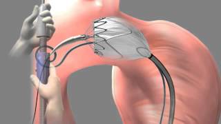 Thoracic Aortic Graft  Medical Animation by Watermark [upl. by Osner]