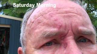 Diary of a Shingle RashHow the virus took over my face [upl. by Mcgregor]