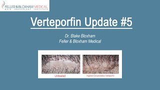 Verteporfin Update 5  Is it Working Whats Next Watch Until the End  Feller amp Bloxham NY [upl. by Etna]