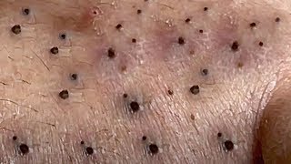 Blackheads Removal Big Acne blackheads Extraction Whiteheads [upl. by Gosnell779]