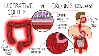 Inflammatory Bowel Disease  Ulcerative Colitis v Crohns Disease With Histology amp Manifestations [upl. by Suk]