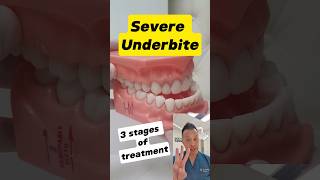 Underbite Treatment Demystified The 3 Essential Stages shorts dentallan dentist [upl. by Elon]