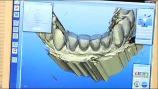 Anterior CEREC Case  Dr James Klim [upl. by Aleil]