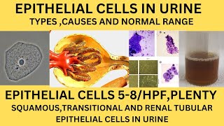 EPITHELIAL CELLS IN URINE ANALYSISTYPES NORMAL RANGE CAUSESRISK OF EPTHELIAL CELLS IN URINE [upl. by Cally]