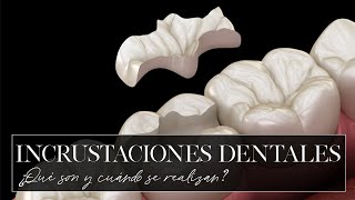 ¿Qué es y cuándo se realiza una incrustación dental [upl. by Buroker]