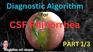 234CSF Rhinorrhea Part 13  Diagnostic Algorithm for Cerebrospinal Fluid Leak surgeryeducation [upl. by Ecile]