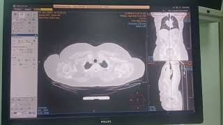 Filming dun scanner thoracoabdominopelvienTAP [upl. by Rima]