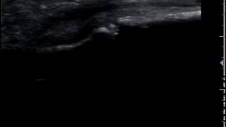 Ultrasound guided steroid injection of the PIP J long axis palmar view out of plane approach [upl. by Hairehcaz]