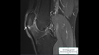 Sinding Larsen Johansson Syndrome [upl. by Ennaillij]