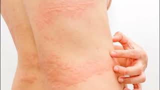 URTICARIA RONCHAS EN EL CUERPO CAUSAS SÍNTOMAS Y TRATAMIENTO [upl. by Mccahill]