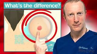 Innocent Skin Lesion or Skin Cancer What should you do [upl. by Sancha]