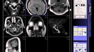 BRAIN MRI NORMAL [upl. by Puto]