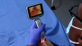 Insighters® iS6 Handheld Video Laryngoscope System  Instructional Video [upl. by Fruma]