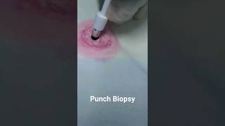 Punch Biopsy Technique doctor hospital [upl. by Aggappera]