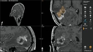 Smartbrush—Volumetric Tumor Outlining by Brainlab [upl. by Alyl333]