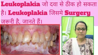 White Patch in mouthLeukoplakia amp its typesWhich Leukoplakia is dangerous amp transform to Cancer [upl. by Annod]