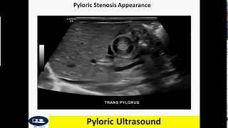 Pyloric ultrasound [upl. by Sibbie]