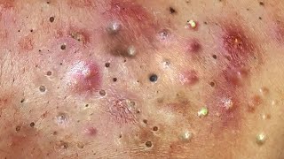 Multiple Blackheads and Whiteheads Removed Togetherlarge blackheads and whiteheads treatment newest [upl. by Pudens]