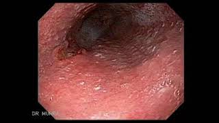 Esofagitis infecciosa por Citomegalovirus [upl. by Mchenry]