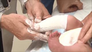 Casting of a Child With Clubfoot Using the Ponseti Method [upl. by Alviani]