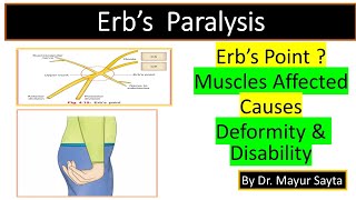 Erbs Paralysis [upl. by Ennovyhc392]