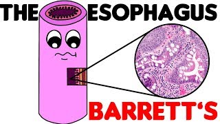 Esophagus Histology  3 Barretts Esophagus [upl. by Jeanette]