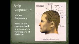 Scalp Acupuncture Overview [upl. by Sihunn]