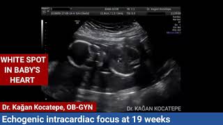 Intro to Fetal Heart Tracings  Contractions 02 of 11 [upl. by Had]