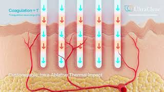 Introducing UltraClears 3DIntelliPulse® Technology [upl. by Atoiyanap]