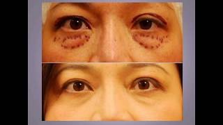 ChaseLayMD Ptosis Droopy Eyelid Surgery [upl. by Nylessoj]